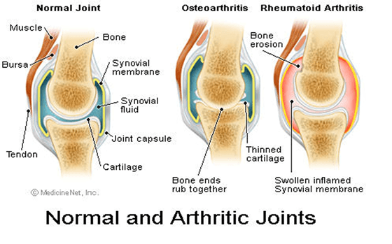 Best Exercises for Joint Pain Image Showing Normal and Arthritic Joints